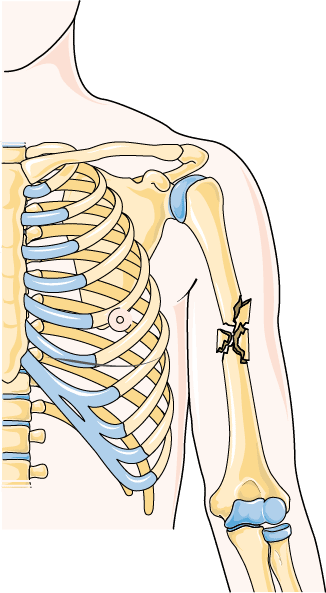 Rehabilitacja po złamaniu kości ramiennej